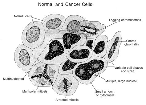 What Are The Stages Of Cancer Blue Ridge Radiation Oncology Brro