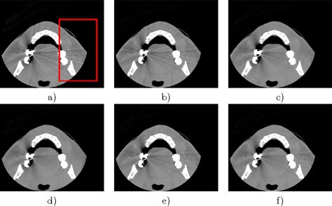 Metal Artifact Reduction In Dental Ct Images Using Polar Mathematical