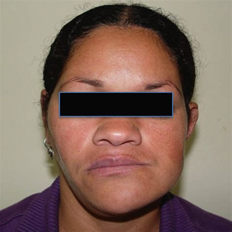 A Clinical Facial Aspect Before Surgery The Patient Presented Facial Download Scientific