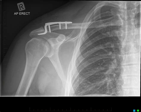 Traumatic Posterior Sternoclavicular Joint Dislocation Current