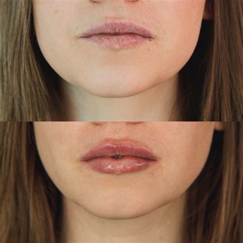 Ihre Ästhetik: Hyaluron-Filler für die Lippen bei Heilpraktikerin