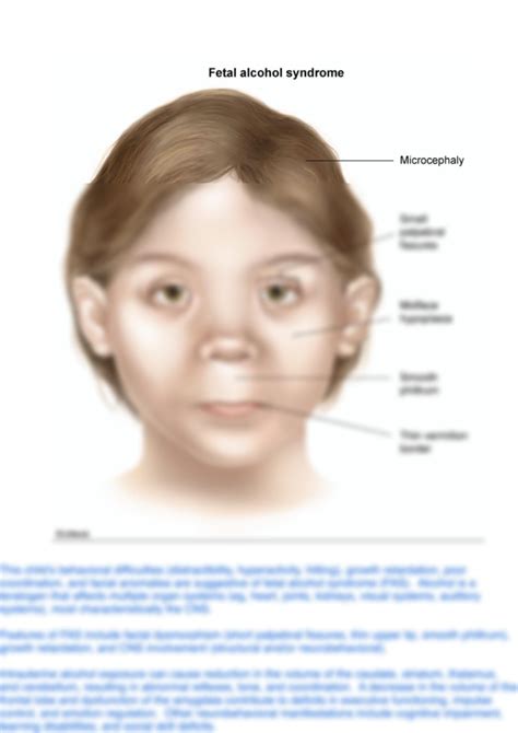 Solution Fetal Alcohol Syndrome Studypool