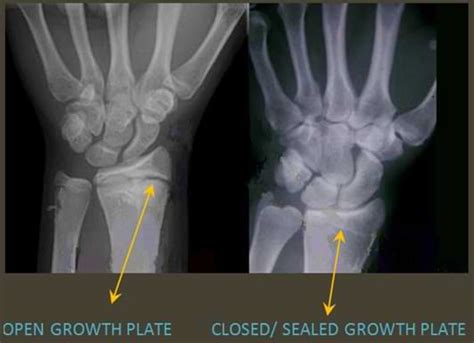 How to keep growth/ epiphyseal plates open – GTWSL