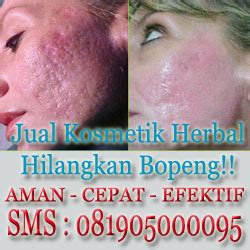 Bagaimana Menghilangkan Bopeng Bekas Jerawat Tips Kecantikan