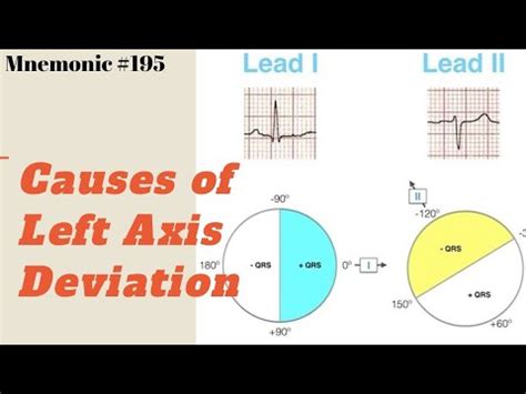 What Are The Causes Of Left Axis Deviation Ecg A Simple Mnemonic To