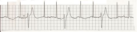 Float Nurse: EKG Rhythm Strips: Bigeminy, Trigeminy, Quadrageminy