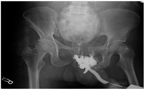 Fluoroscopy And Urethral Anatomy