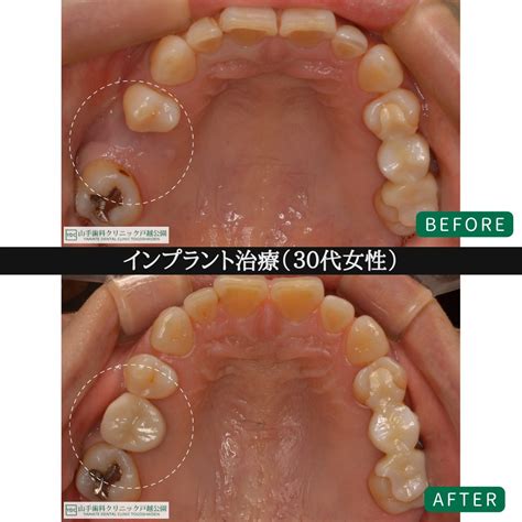 症例紹介5：インプラント治療（30代女性） 東京都品川区 Ydc審美インプラント治療専門ガイド｜山手歯科クリニック大井町・戸越公園