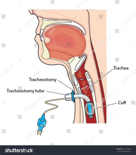 Tracheostomy Tube In Situ Stock Vector Royalty Free