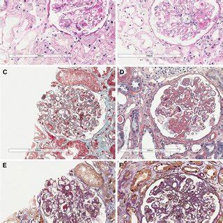 Light microscopy findings in hypocryoglobulinaemic glomerulonephritis ...