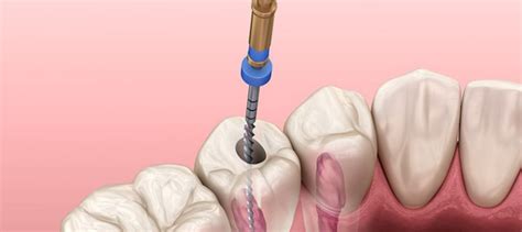 Single Sitting Root Canal Treatment In Badlapur By The Endodontist Rathod Dental Clinic