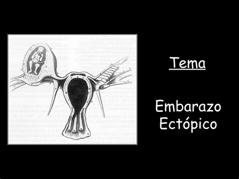 Embarazo Ectópico Ppt