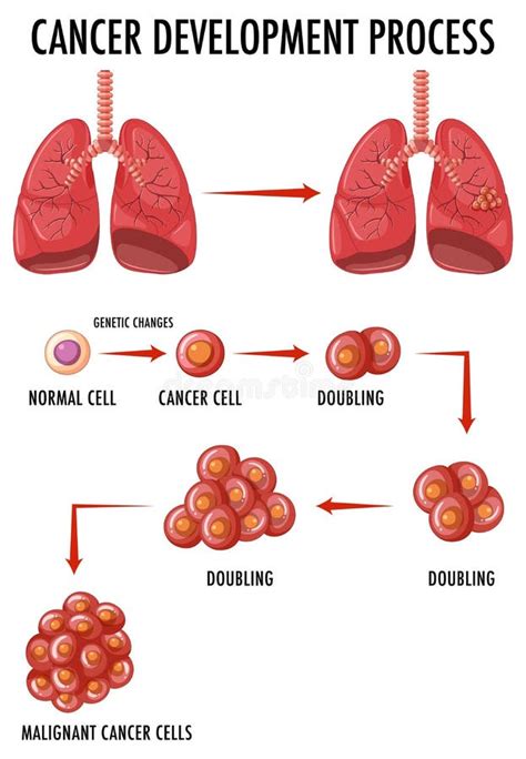 Diagram Showing Normal and Cancer Cells in Human Stock Illustration ...