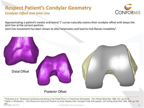 Conformis Patient Specific Custom Total Knee Replacement