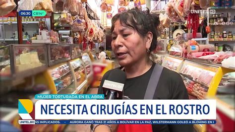 Mujer Torturada Y Quemada En El Penal De El Abra Necesitar Cirug As