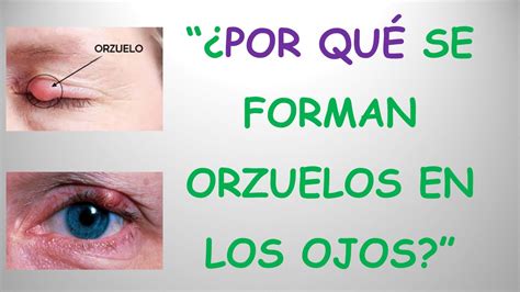 ¿por QuÉ Se Forman Orzuelos En Los Ojos Respuesta Cientifica Youtube