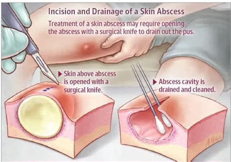 Skin And Soft Tissue Infections Knowledge Amboss Off