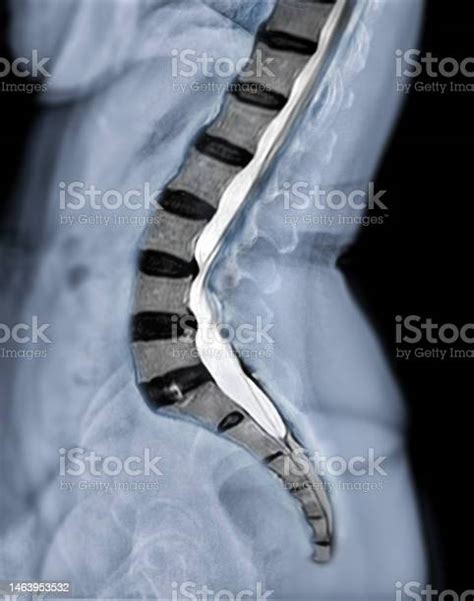 Xray Image Of Lumbar Spine Or Ls Spine Lateral View With Mri Ls Spine For Diagnosis Lower Back