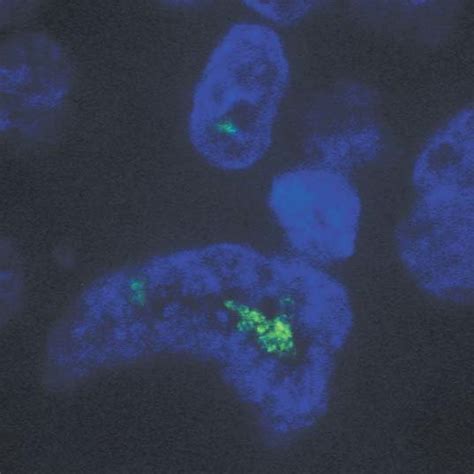 Squamous Cell Carcinoma Strong Her Gene Amplification Cluster With