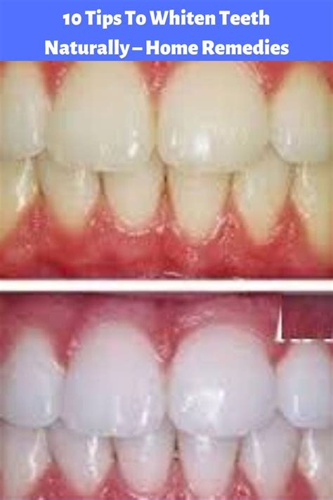 Pin By Kerr Korin On Funny Teeth Whitening Natural Teeth Whitening