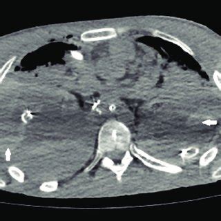 Axial Noncontrast Multidetector Computed Tomography Images Of The Chest