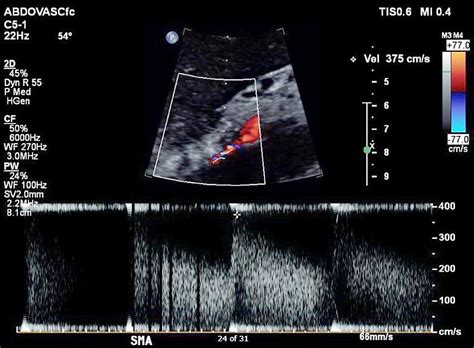 Inferior Mesenteric Artery Ultrasound