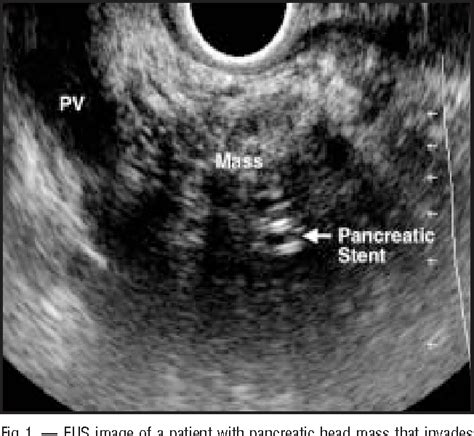 Applications Of Endoscopic Ultrasonography In Pancreatic Cancer