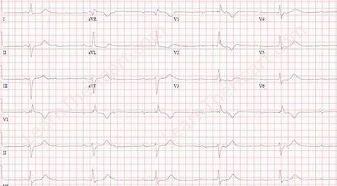 Third Degree AV Block ECG (Example 5) | Learn the Heart