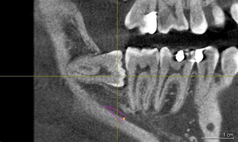 I Denti Del Giudizio Studio Dentistico Galletti