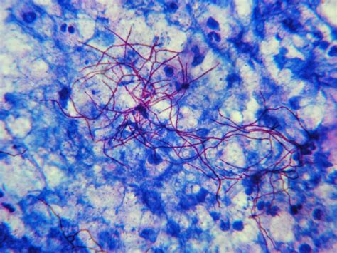 Nocardia - Microbiology - Medbullets Step 1