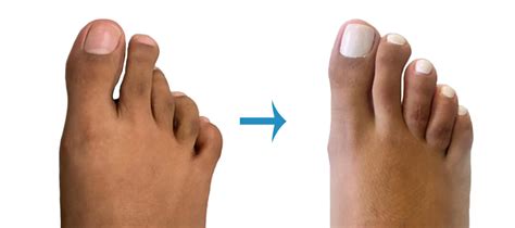 Before And After Foot Surgery Image Gallery London Foot And Ankle Surgery