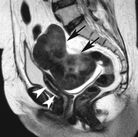 Functioning Ovarian Tumors Direct And Indirect Findings At Mr Imaging