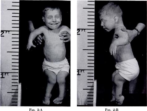 Figure 1 from [Diastrophic dwarfism]. | Semantic Scholar