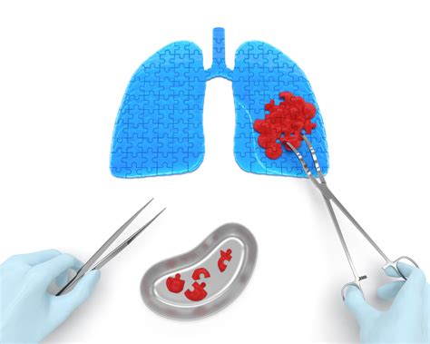 New Scoring System For Lung Cancer Diagnostic Test Developed To Better