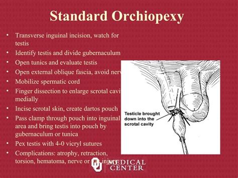 Undescended Testicle