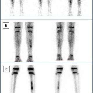 a. Three-phase bone scan from the legs: Upper row (A): anterior images ...