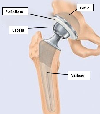 Gu A Pr Ctica Para Pacientes Con Pr Tesis Total De Cadera Dr Enrique