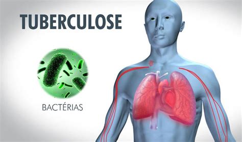 Journée Mondiale De La Tuberculose Le Taux Dincidence En Tunisie Est