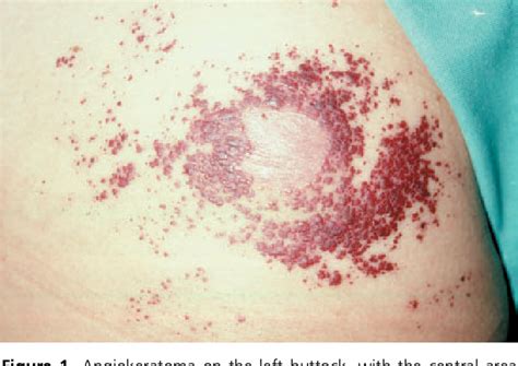 Angiokeratoma Circumscriptum Naeviforme Successful Treatment With Carbon‐dioxide Laser