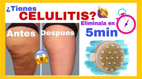 como ELIMINAR la CELULITIS de las piernas y glúteos RAPIDAMENTE EN