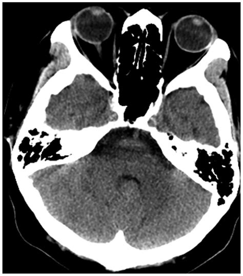 Medulloblastoma in an elderly patient: A case report and literature review