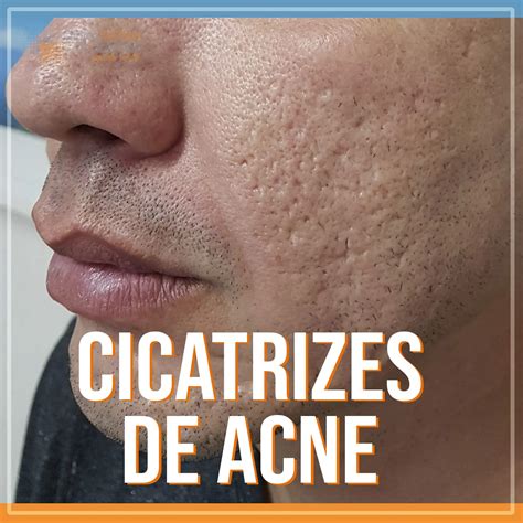 Cicatrizes De Acne Tratamentos Dermatol Gicos Especialista Desde