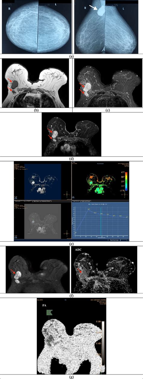 70-year-old female presented with right axillary tail lump. a ...