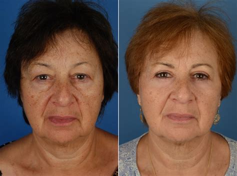 Maximizing Scar Healing After Eyelid Surgery