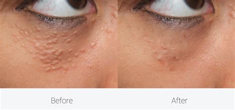 syringoma removal cutis dermatology