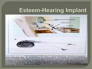 Middle ear implants