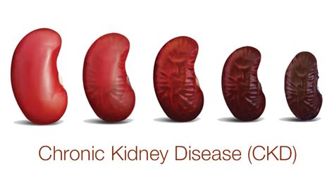 CKD (CHRONIC KIDNEY DISEASE)