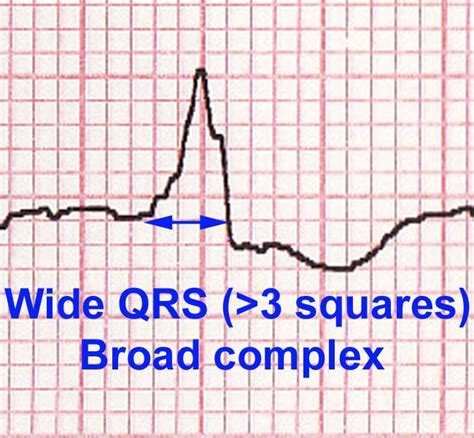 Clinical Ecg Ekg Interpretation Basics How To Read Mi Myocardial Infarction Angina