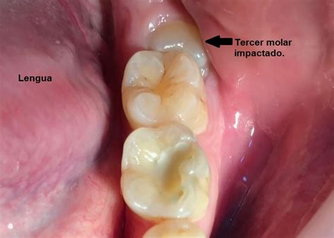 Muela Del Juicio Semi Impactada