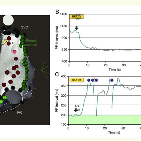 A And C Electro Anatomical Maps Of The Left Atrium At The Th And